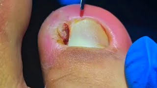 Patient Feels Instant Relief After Pedicurist Pulls Out Massive Ingrown Toenail [upl. by Yesnil]