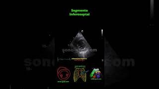 Ecocardiografía  Hipocinesia Inferolateral E Inferior [upl. by Birgitta]