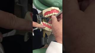 Instrumentation on Mandible with Universal Curettes part 1 [upl. by Aynotak]