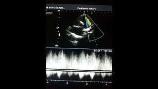 Patent Ductus Arteriosus  Echocardiography [upl. by Bum]