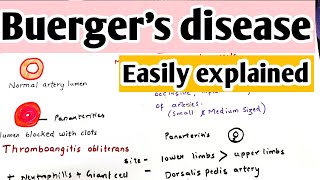 Buergers disease  Thromboangitis obliterans  Definition causes pathophysiology treatment [upl. by Aimas]