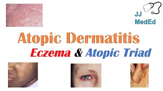 Eczema Atopic Dermatitis  Atopic Triad Triggers Who gets it Why does it happen amp Treatment [upl. by Carnay279]