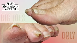 👣Big Toes Only  THICK Pincer Toenail Pedicure👣 [upl. by Chryste]