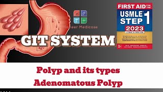 USMLE Step1 Polyp and its types Adenomatous Polyps from first aid step 1USMLEUrduHindi [upl. by Tamera957]