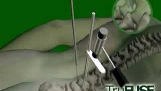 TruFUSE Facet Fusion Procedure [upl. by Hiller]