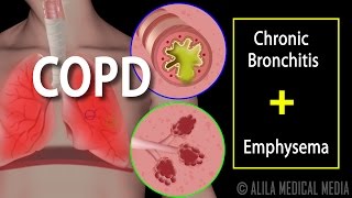 COPD  Chronic Obstructive Pulmonary Disease Animation [upl. by Newton]