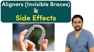 Aligners Invisible Braces के Side Effects  Dr Ankit  Seraphic Dental Indore [upl. by Novat]