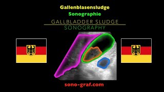 Sonographie  Gallenblasensludge [upl. by Pazice]