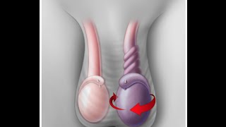 Testicular Torsion [upl. by Enialahs]