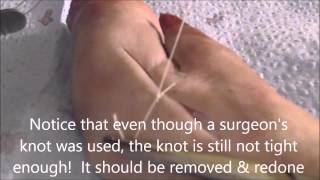 How to Put in Simple Interrupted Sutures Using a Curved Needle and the Rule of Halves [upl. by Noryk]