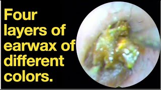 Four layers of earwax of different colorsear wax removal  ear cleaning  ASMR  relaxation relax [upl. by Yvon]