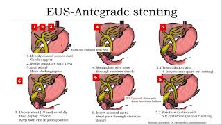 Endoscopic Ultrasound EUS Series 5 Biliary Drainage Eng Version [upl. by Airotnahs729]