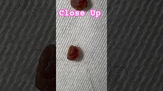 fungus spores mold skin flukes morgellons myjourney skin condition ulcer help share win [upl. by Amelus]