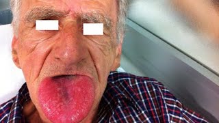 ANGIOEDEMA  Causes Symptoms Treatment Diagnosis  Hereditary Angioedema  Angiodema vs Urticaria [upl. by Nywde]