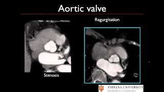 Post Processing Cardiac CT [upl. by Pius553]