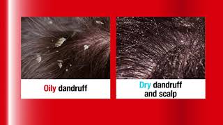 Alpecin Hybrid Caffeine Shampoo  Fight dry dandruff and hair loss [upl. by Bernardo]