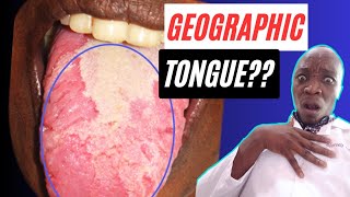 What is a Geographic Tongue  Benign Migratory Glossitis Treatment for a Geographic Tongue [upl. by Aerdnahs]