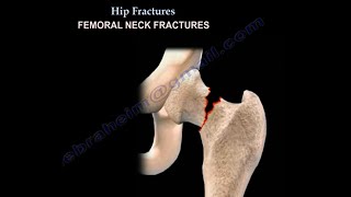 Hip Fractures types classification and treatment [upl. by Eissen]