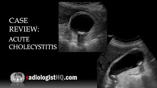 Ultrasound of Acute Cholecystitis [upl. by Laurentia]