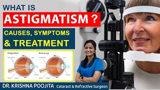 What is Astigmatism  Astigmatism Causes amp Treatment  Dr Krishna poojita  Pixel eye hospital [upl. by Veal]