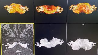 رنين مغناطيسي علي الاذن الداخليه والقوقعة MRI CPAInternal Auditory Canal IAC T2 Space 3D sequence [upl. by Cassilda]