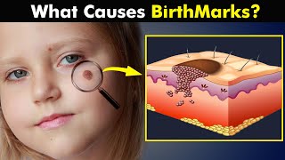 Birthmarks  How Birth Marks Develops In Our Skin UrduHindi [upl. by Petty]