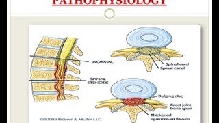 Spinal Stenosis  Medical PowerPoint Presentation [upl. by Amatruda]