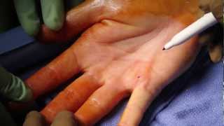 5 Dupuytrens Contracture [upl. by Suk]