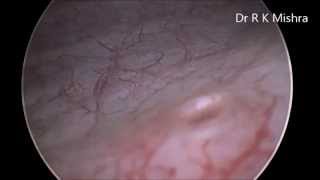 Diagnostic Cystoscopy [upl. by Duvall]