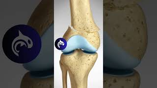 See how a Supracondylar Fracture of the Knee and Surgical Fixation works in 3D Animation [upl. by Benis]