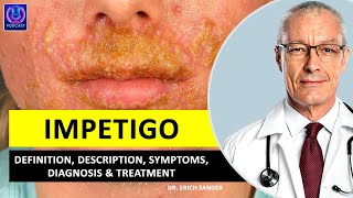 IMPETIGO Definition Description Causes and symptoms Diagnosis amp Treatment of Impetigo [upl. by Glick]