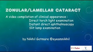 ZonularLamellar Cataract [upl. by Gawen282]