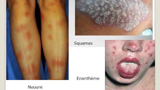 INFECTIOLOGIE Eruption cutanée 2016 [upl. by Eycats]