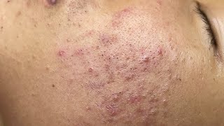 ACNE TREATMENT VU QUYNH MI Blackheads On Boy Face 2024 [upl. by Dante]