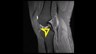 Knee MRI ACL Tear Bucket Handle Medial Meniscus Tear [upl. by Hsivat]