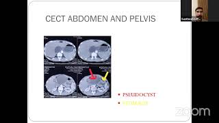 PG CLINICS RIGHT HYPOCHONDRIUM MASS EPIGASTRIC MASS [upl. by Anina85]