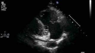 Transthoracic ECHO Parasternal Long RV Inflow View [upl. by Celestia]