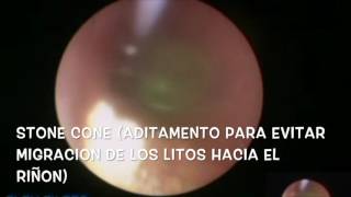 LITIASIS URETERAL URETEROSCOPIA [upl. by Filipe131]