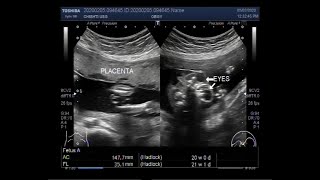 Ultrasound Video showing Fetal anomaly Anencephaly [upl. by Eilak729]