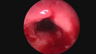 Subglottic stenosis [upl. by Ahsoyem]