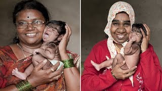 Baby Girl With Covered In Hair Has Familys Rare Gene [upl. by Jeth]