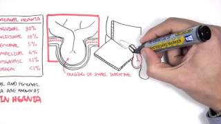 Introduction to Direct and Indirect Inguinal Hernia [upl. by Anialam]