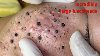 Incredibly large blackheads [upl. by Yuria441]