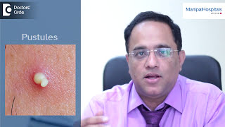 When To Visit A Dermatologist For Acne  Best Dermatologist In Bangalore  Manipal Hospitals [upl. by Gleda]