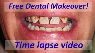 Free Dental Makeover Time lapse Video [upl. by Riffle]