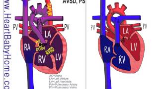 25  Total Anomalous Pulmonary Vein Return TAPVR with DORV AVSD ps [upl. by Aziza471]