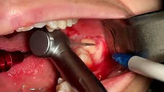 partially impacted lower wisdom tooth extraction [upl. by Aggy939]