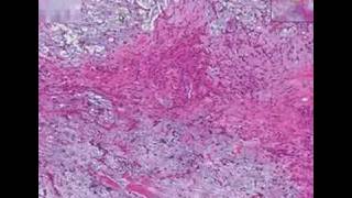 Histopathology Salivary glandPleomorphic adenoma mixed tu [upl. by Llezo]