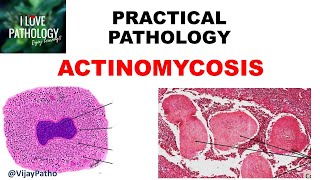 Practical Pathology ACTINOMYCOSIS [upl. by Otreblada458]