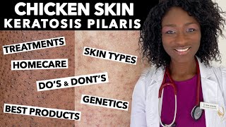 Keratosis Pilaris Chicken Skin  Treating Dry Bumpy Skin  Special Tips for Black Skin  Ask Doctor [upl. by Boyer160]